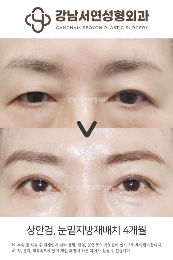 상안검, 눈밑지방재배치 4개월 전후 비교 사진