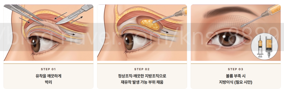 쌍꺼풀 수술 설명 도해