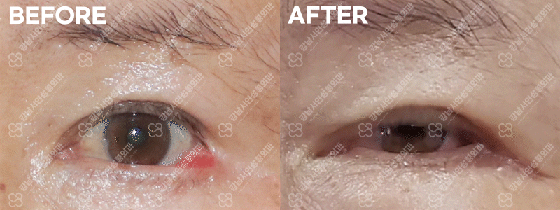 뒤트임 복원 BEFORE / AFTER