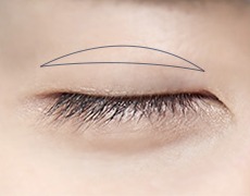 남자 절개 눈매교정 STEP 02
