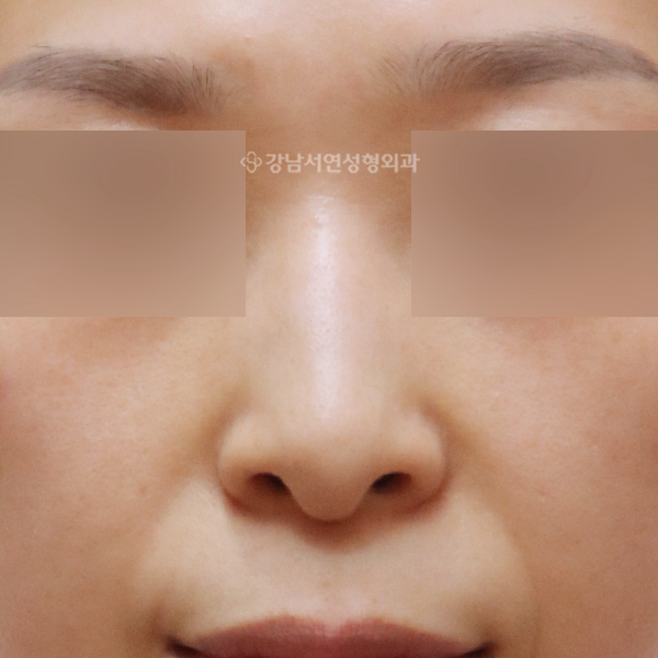매부리코성형 BEFORE