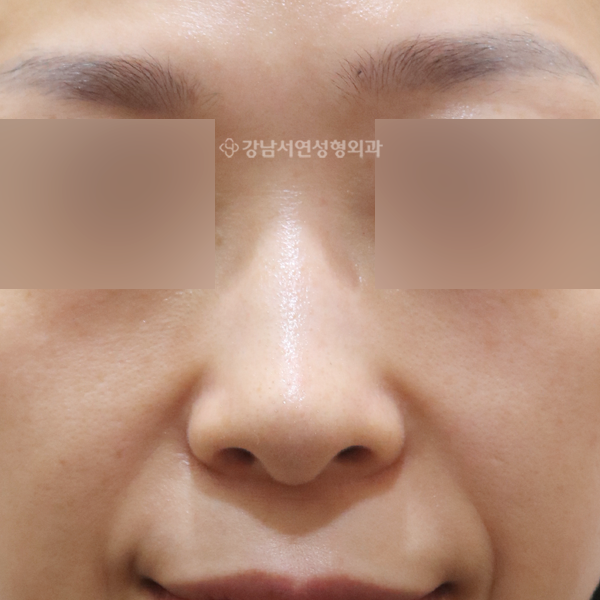 매부리코성형 AFTER
