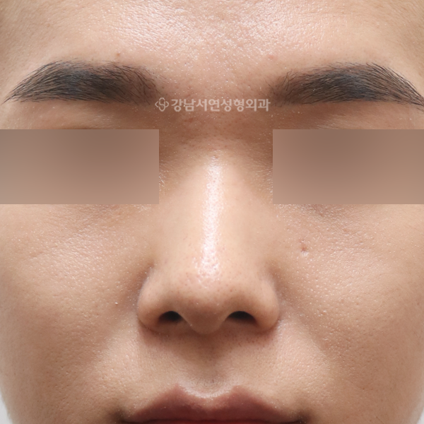 무보형물 코성형 정면 AFTER