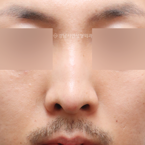 코성형 BEFORE