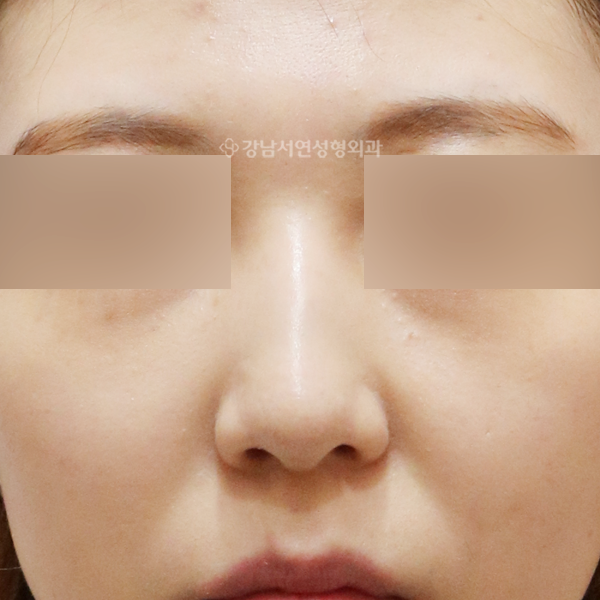코성형 BEFORE