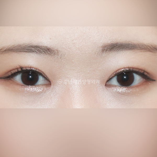 절개눈매교정+앞트임 AFTER