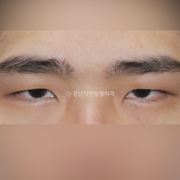 절개눈매교정+앞트임 BEFORE