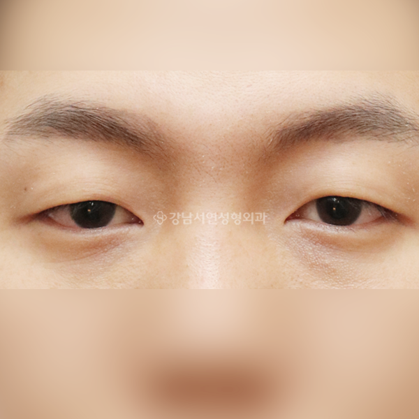 절개눈매교정 BEFORE