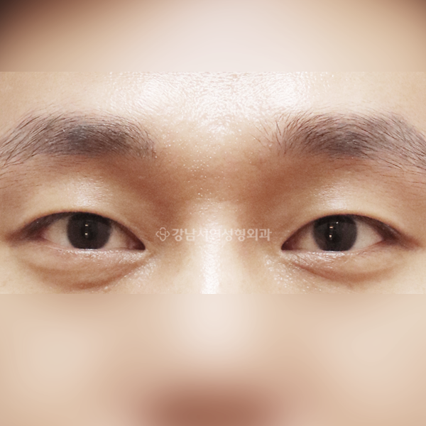절개 쌍꺼풀 재수술 AFTER