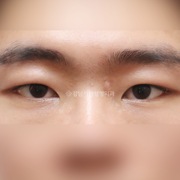 절개눈매교정 AFTER