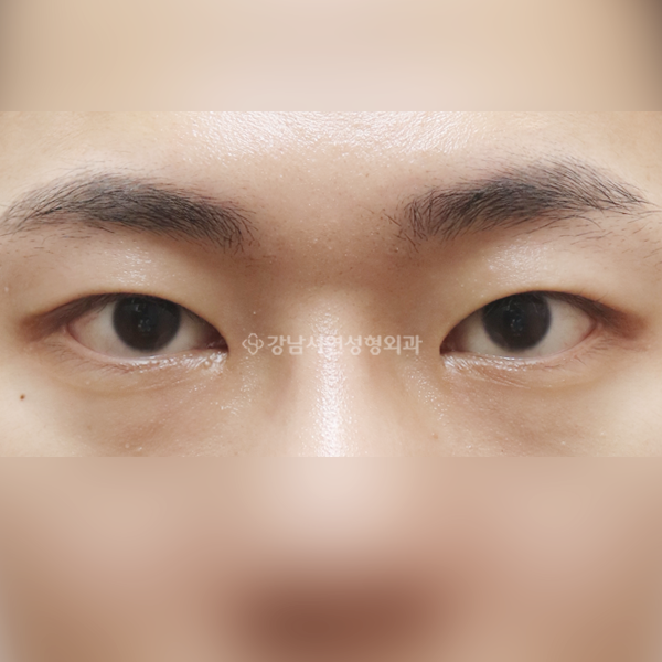절개눈매교정+앞트임+뒷트임 AFTER