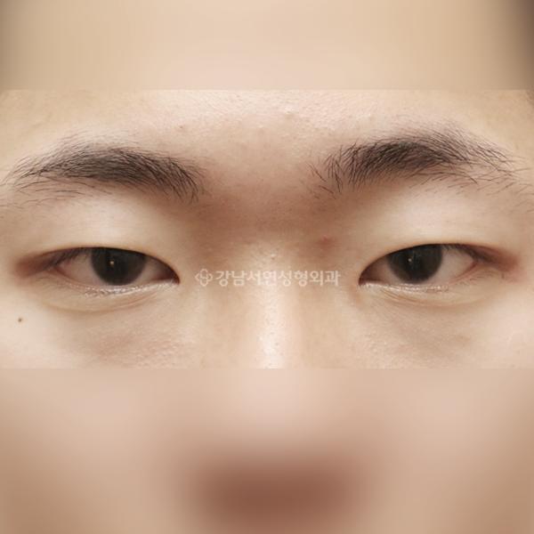 절개눈매교정+앞트임+뒷트임 BEFORE