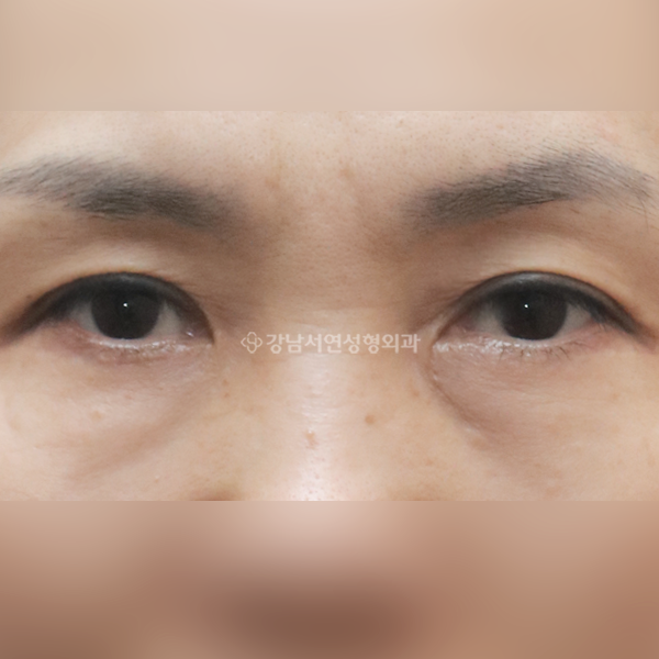 상안검+하안검+앞트임 AFTER