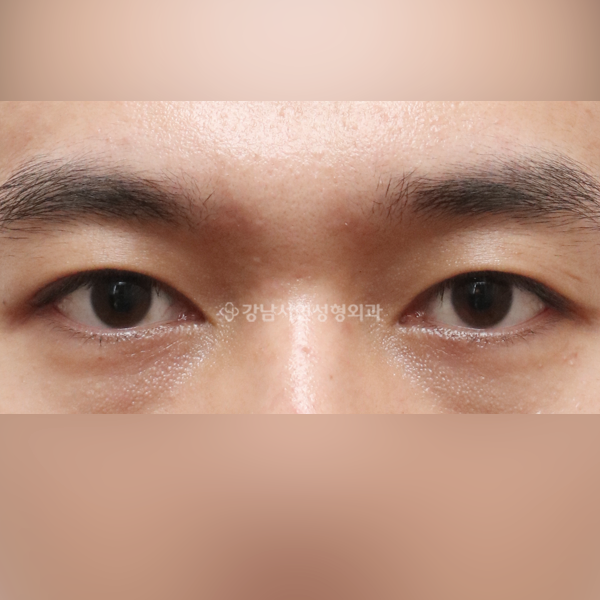 절개눈매교정 AFTER