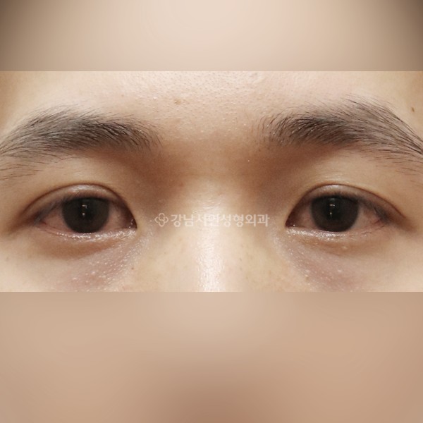 절개눈매교정 BEFORE