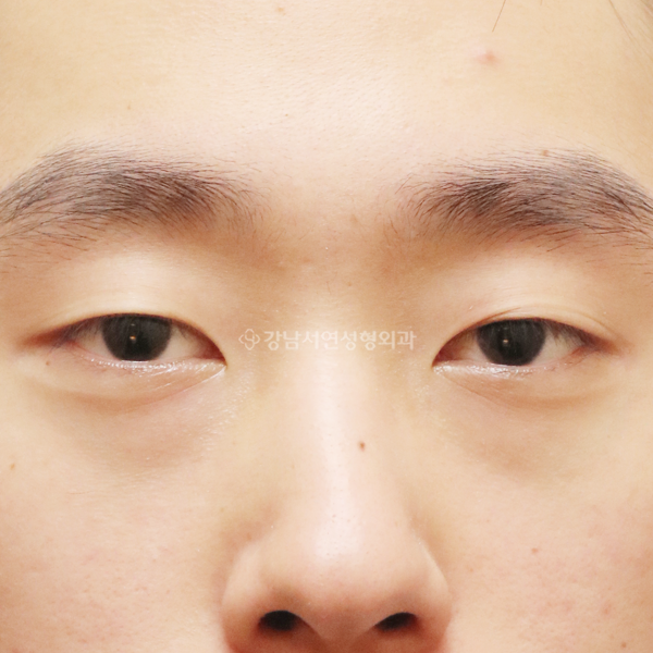 절개눈매교정+앞트임 BEFORE