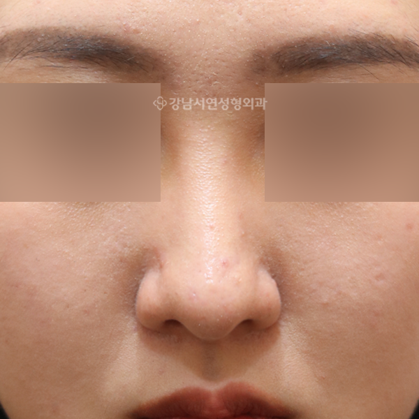 여자코성형 AFTER