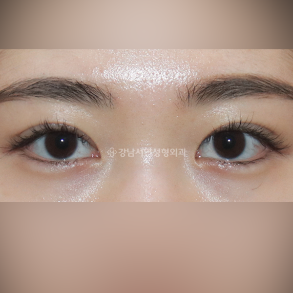 자연유착 쌍꺼풀 AFTER