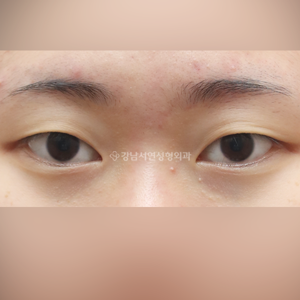 자연유착 쌍꺼풀 BEFORE