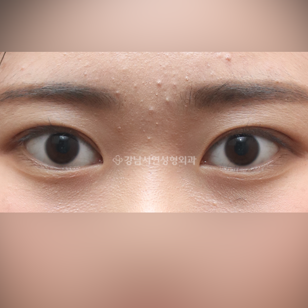 자연유착 쌍꺼풀 AFTER