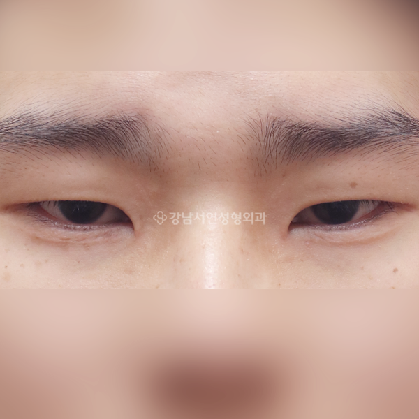 절개눈매교정 앞트임 뒤트임 밑트임 BEFORE