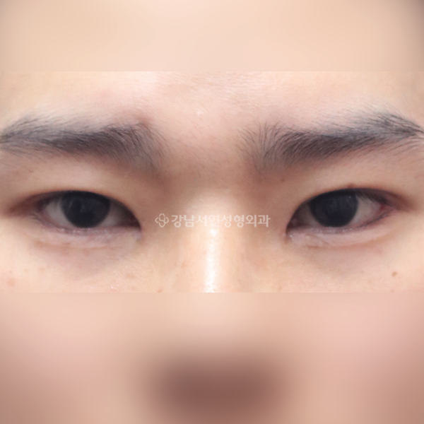 절개눈매교정 앞트임 뒤트임 밑트임 AFTER