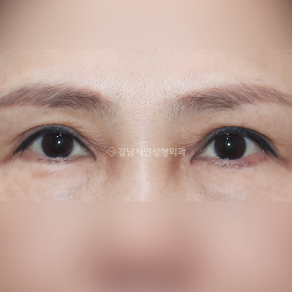 상안검 재수술 AFTER