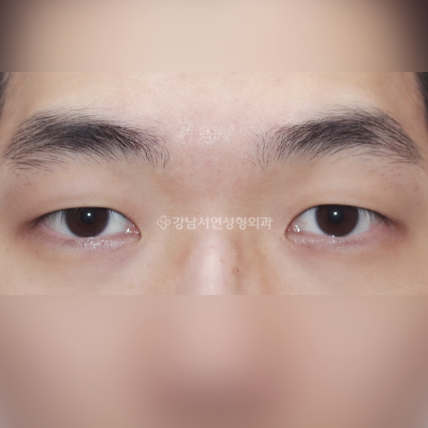 절개눈매교정 BEFORE
