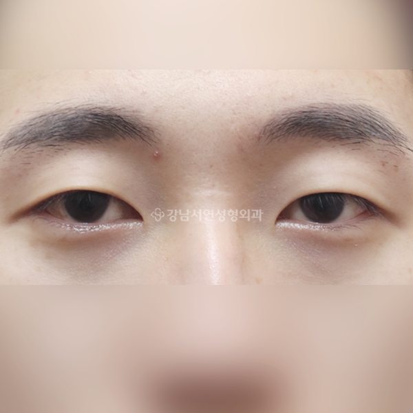 절개눈매교정 앞트임 BEFORE