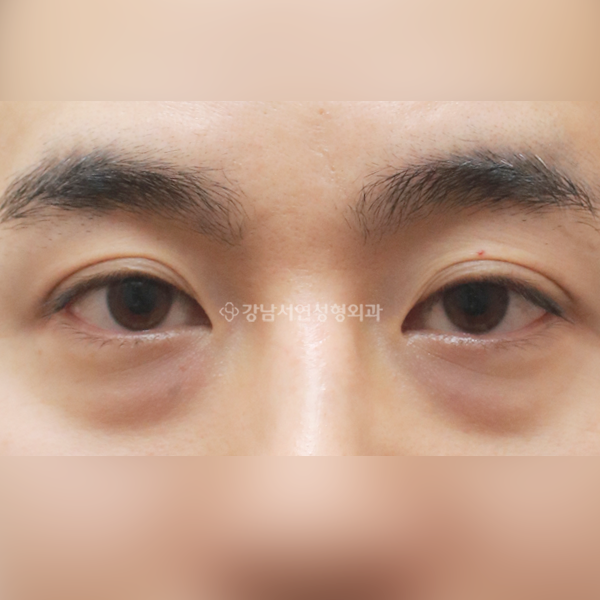 눈밑지방재배치 BEFORE