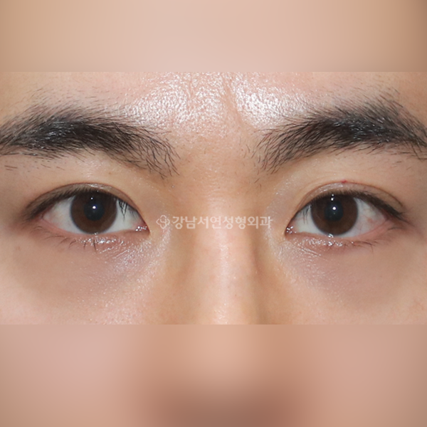 눈밑지방재배치 AFTER