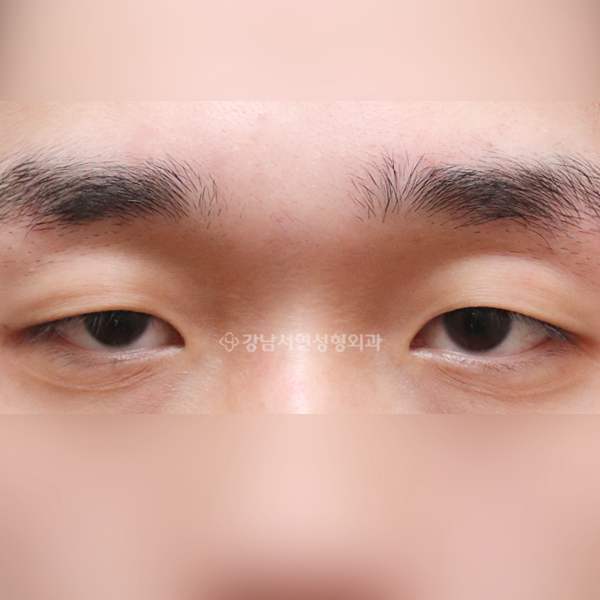 절개눈매교정 BEFORE