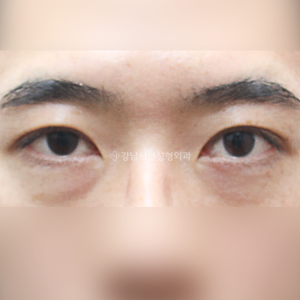 절개눈매교정 AFTER