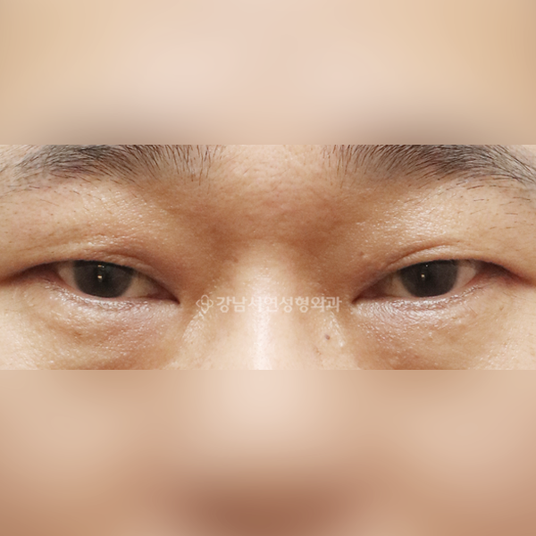 절개눈매교정+뒷트임+밑트임 BEFORE