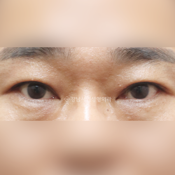 절개눈매교정+뒷트임+밑트임 AFTER