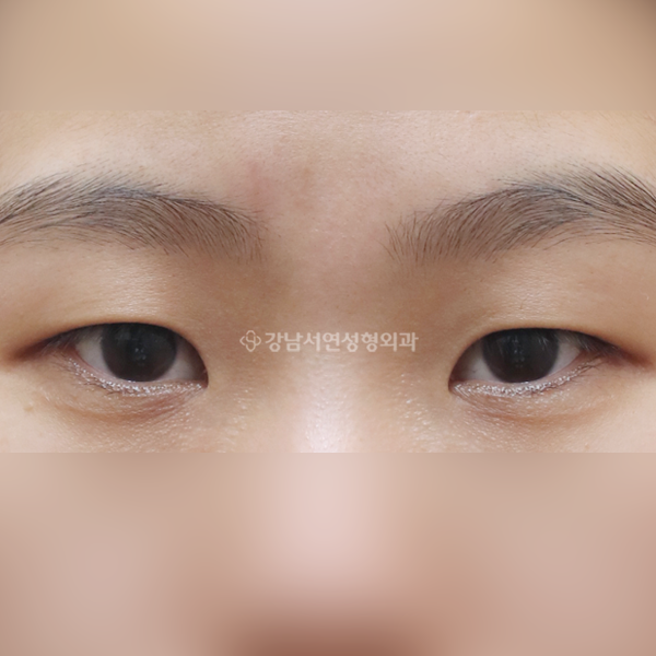 절개눈매교정+앞트임 BEFORE