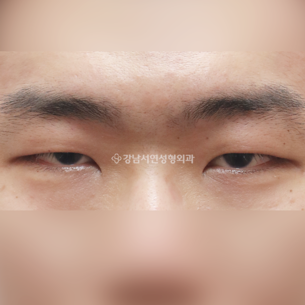 절개눈매교정+앞트임 BEFORE