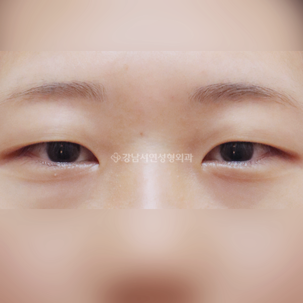 절개눈매교정+앞트임 BEFORE