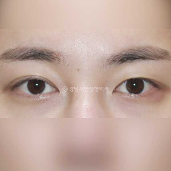 절개 쌍꺼풀 재수술 BEFORE