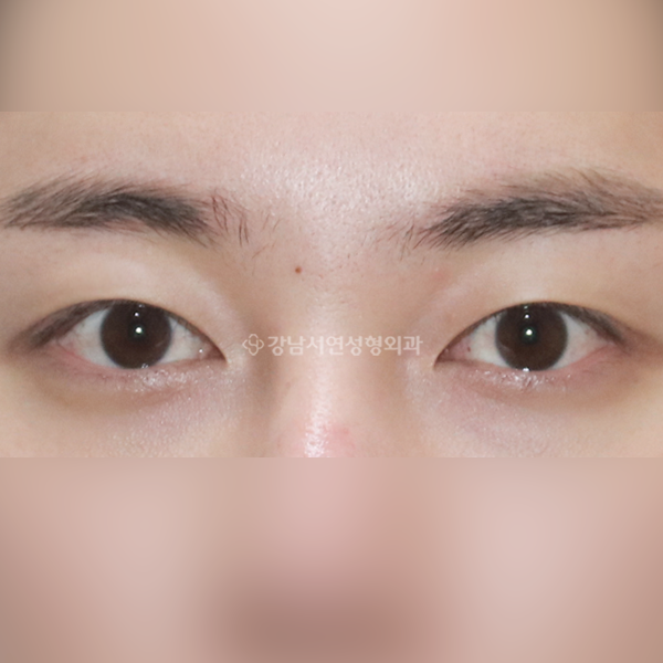 절개 쌍꺼풀 재수술 AFTER