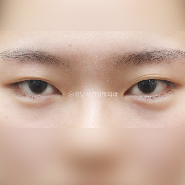 절개눈매교정 재수술 BEFORE