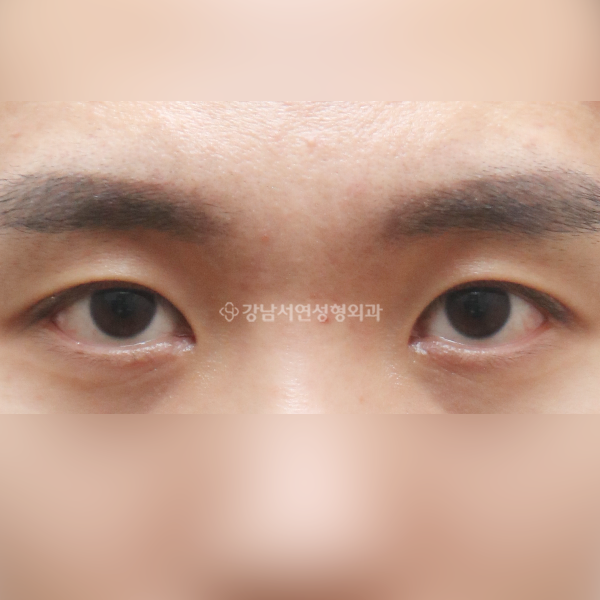 절개눈매교정+앞트임 AFTER