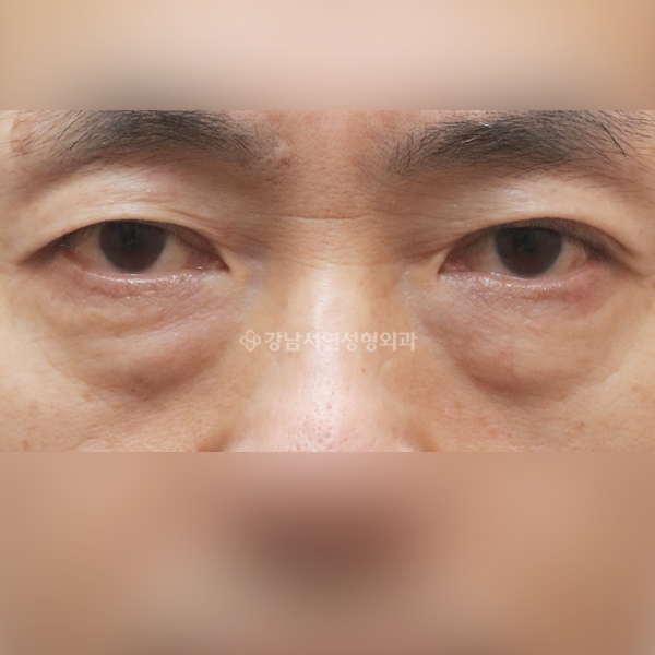 하안검 BEFORE