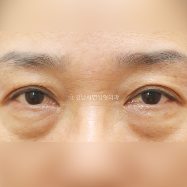 하안검 BEFORE