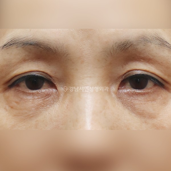 하안검 + 눈썹하거상 BEFORE