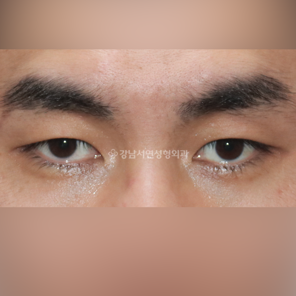 절개눈매교정 BEFORE