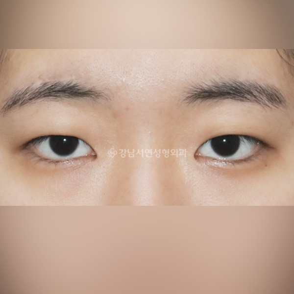 절개눈매교정+앞트임 BEFORE