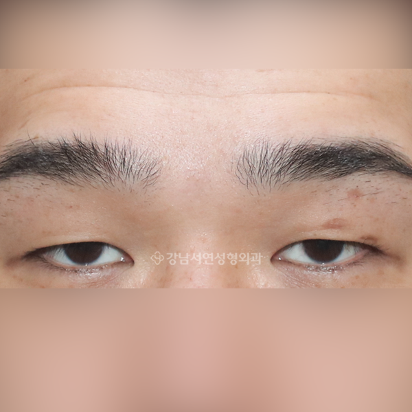 절개눈매교정 BEFORE