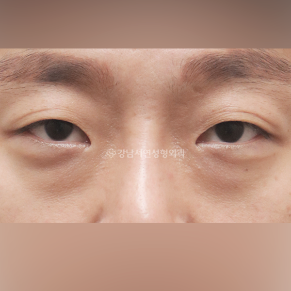 무쌍눈매교정 BEFORE