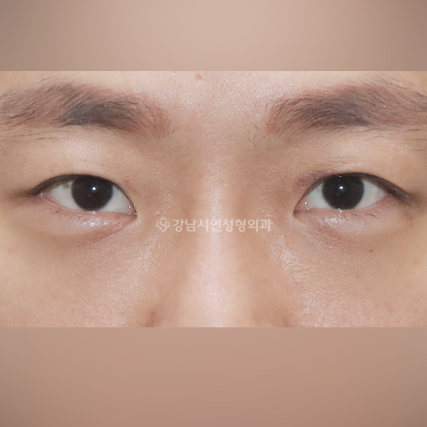 무쌍눈매교정 AFTER